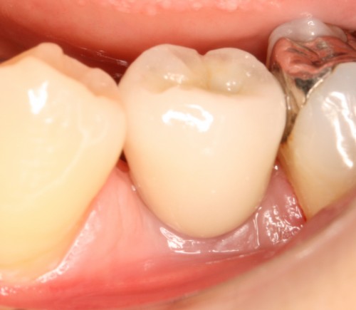松本11　上部構造装着直後